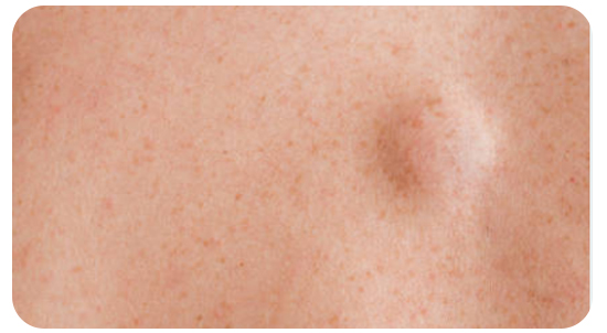 Exceresis de lipomas