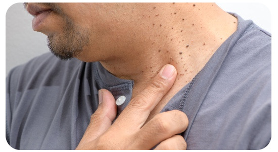 Exceresis de nevos o verrugas