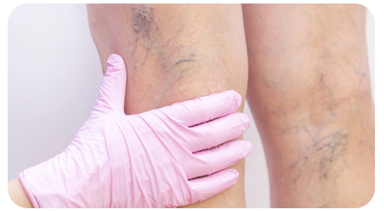 Insuficiencia venosa